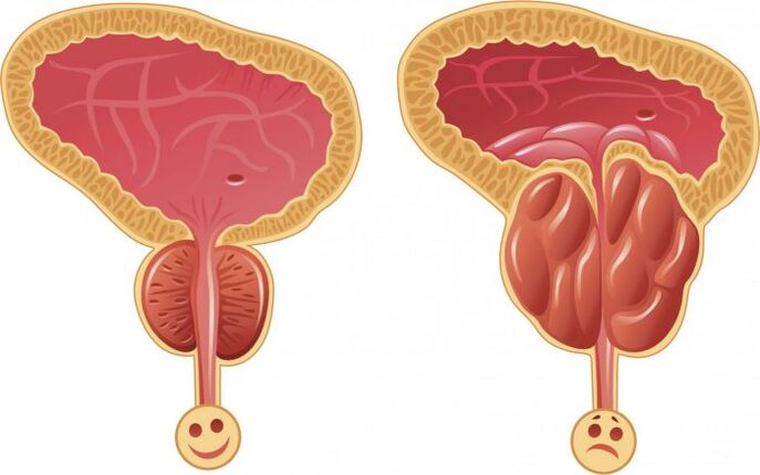 prostata sana e infiammata con prostatitestat