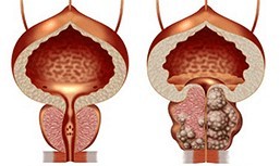 È sano e non sano prostata