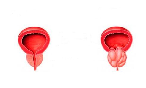 prostata sana e infiammata con prostatite