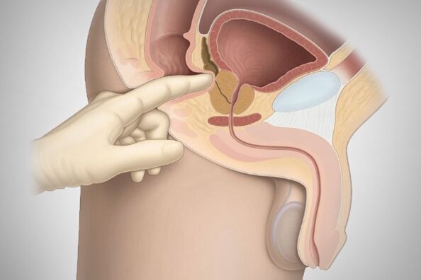 Massaggio prostatico per prostatite batterica