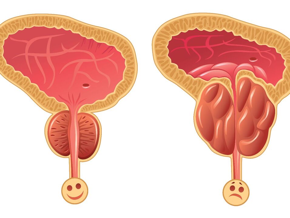 Ghiandola prostatica sana e congestione della prostata con prostatite congestizia