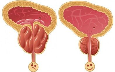 come funziona Prostalix per la prostatite prima e dopo il trattamento